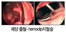 궤양 출혈-hemoclip 지혈술 사진